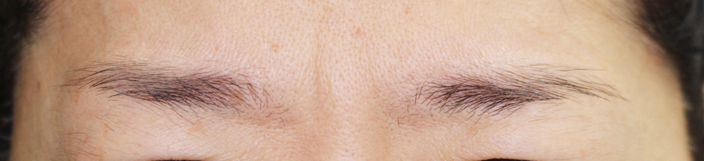 ボトックス症例写真7-2