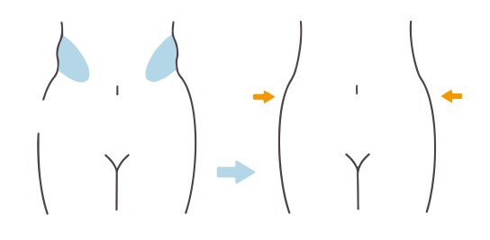 わき腹・腰：1箇所のみの施術の図