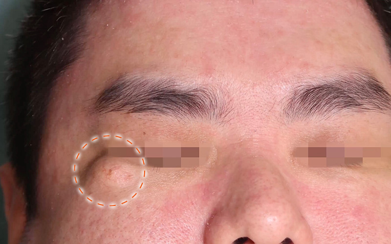 粉瘤の背用例写真