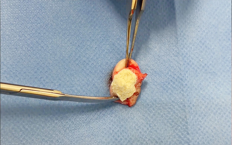 摘出した粉瘤の写真